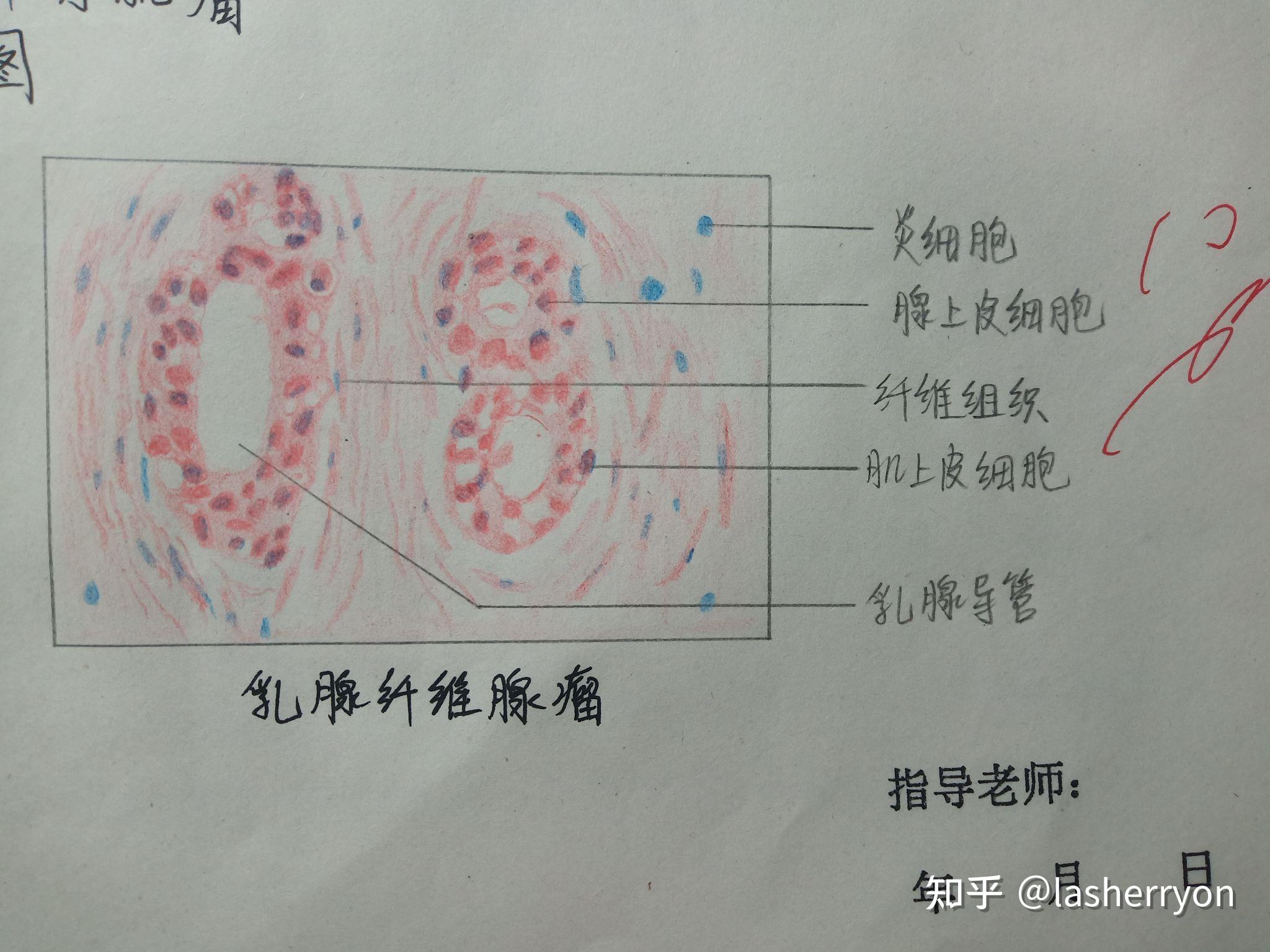 纤维瘤病理切片手绘图片