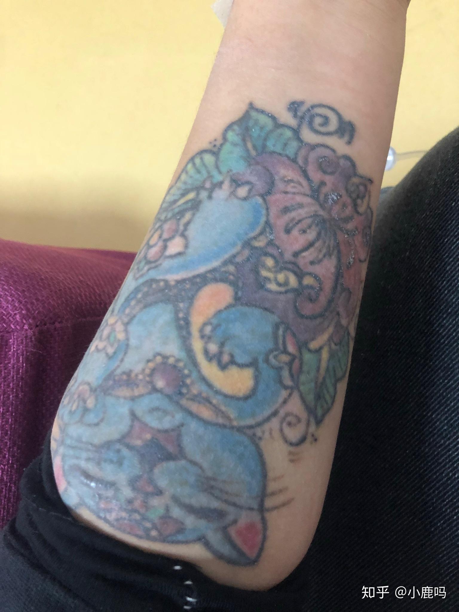 激光洗纹身第二次