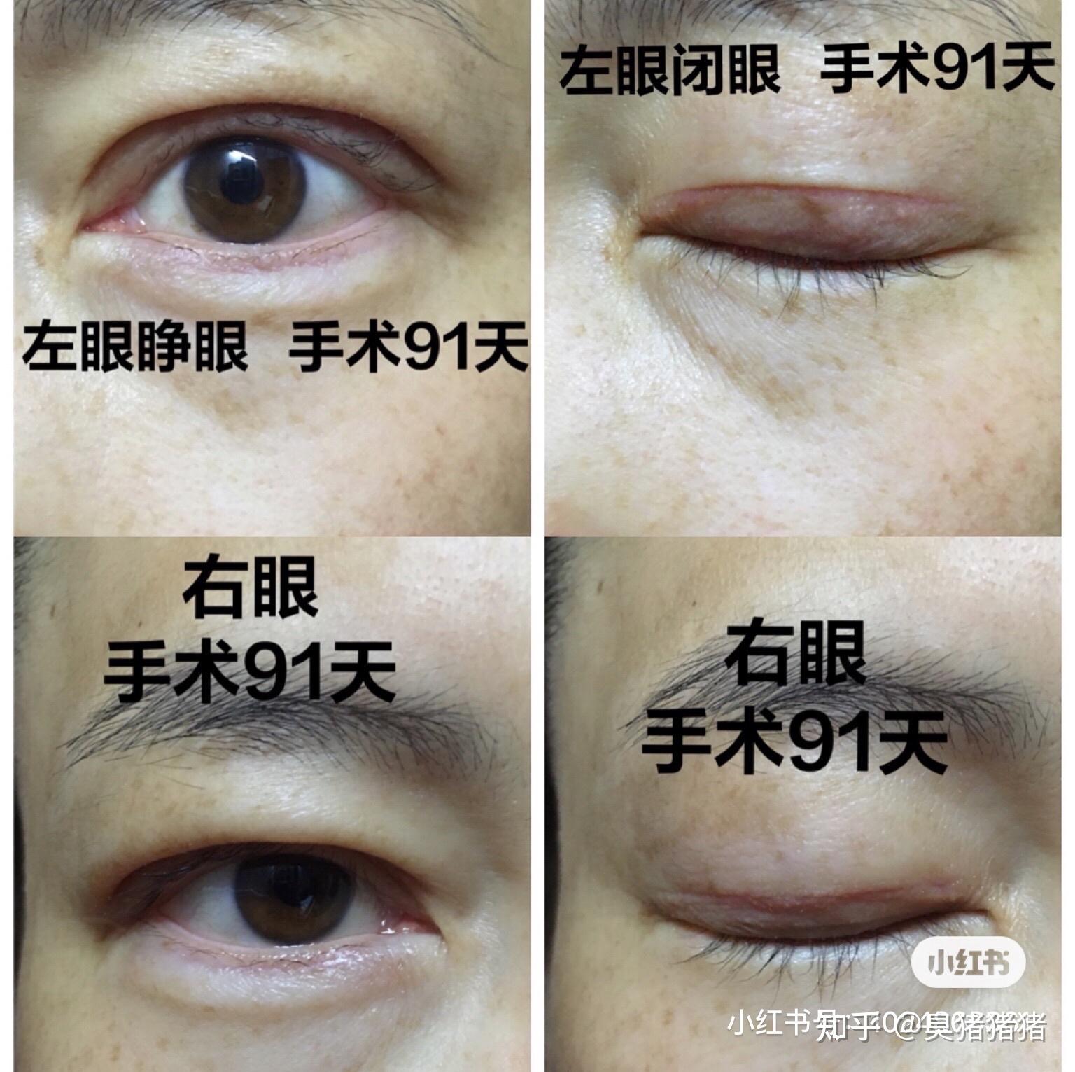 陈其庆双眼皮失败案例