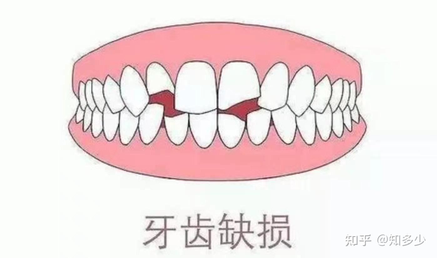 好好牙齒忽然掉了一小塊