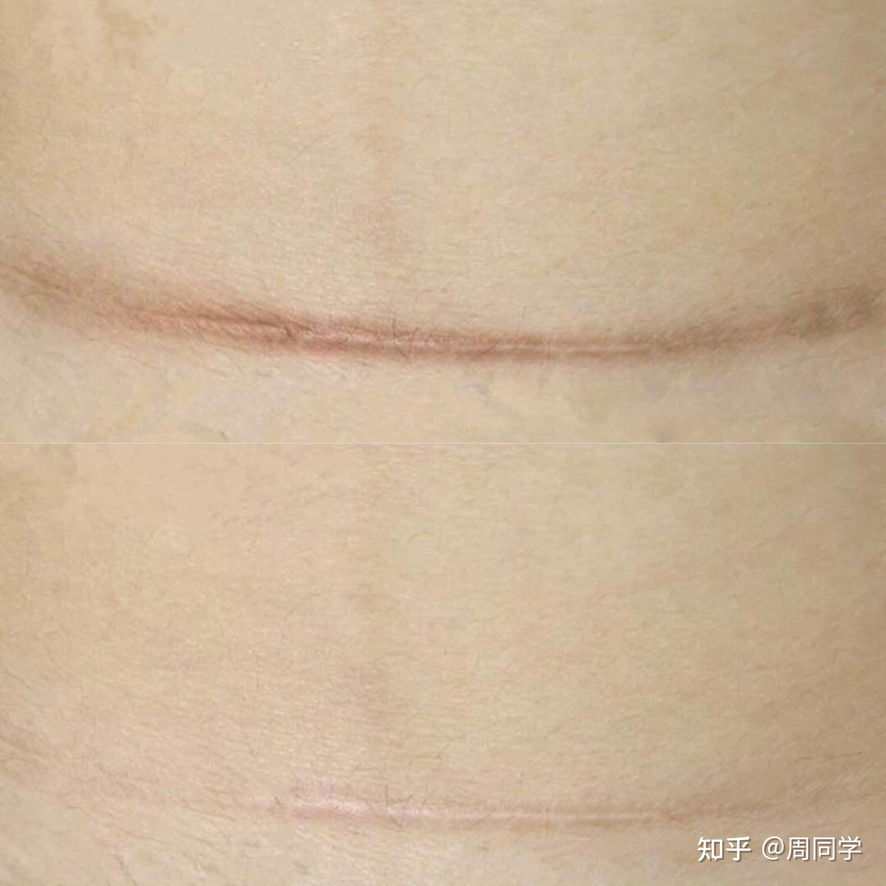 为什么专业人士强烈建议你长疤的时候,一定要敷医用级硅酮阻止疤痕的形成 ?! - 知乎