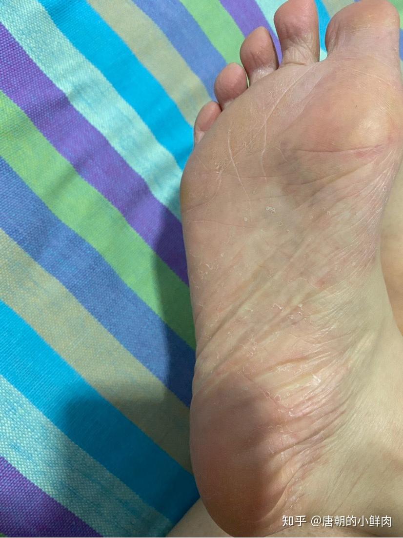 水泡脱皮型的脚气,用醋和艾草是不行的,还是得用药