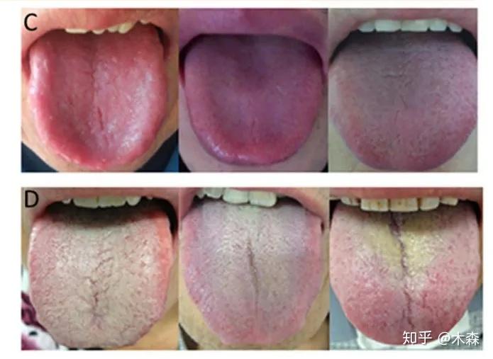 正常舌苔的颜色疾病图片