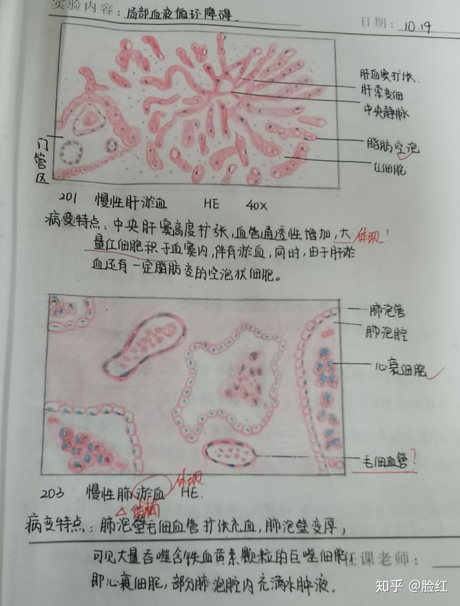肝细胞水肿图 手绘图图片
