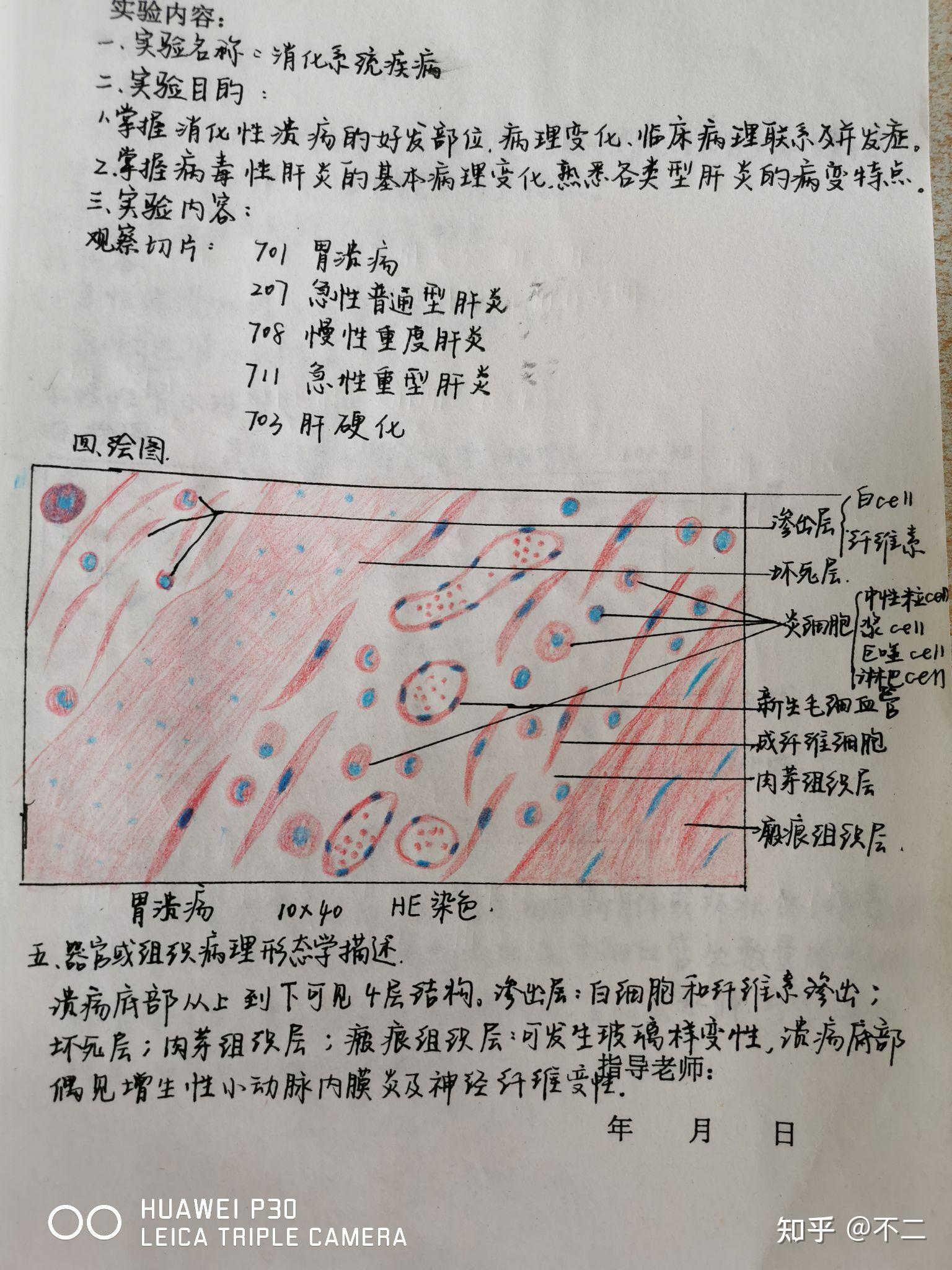 肾浊肿红蓝铅笔图片