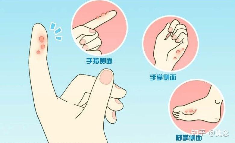 汗疱疹反复发作怎么办? - 知乎