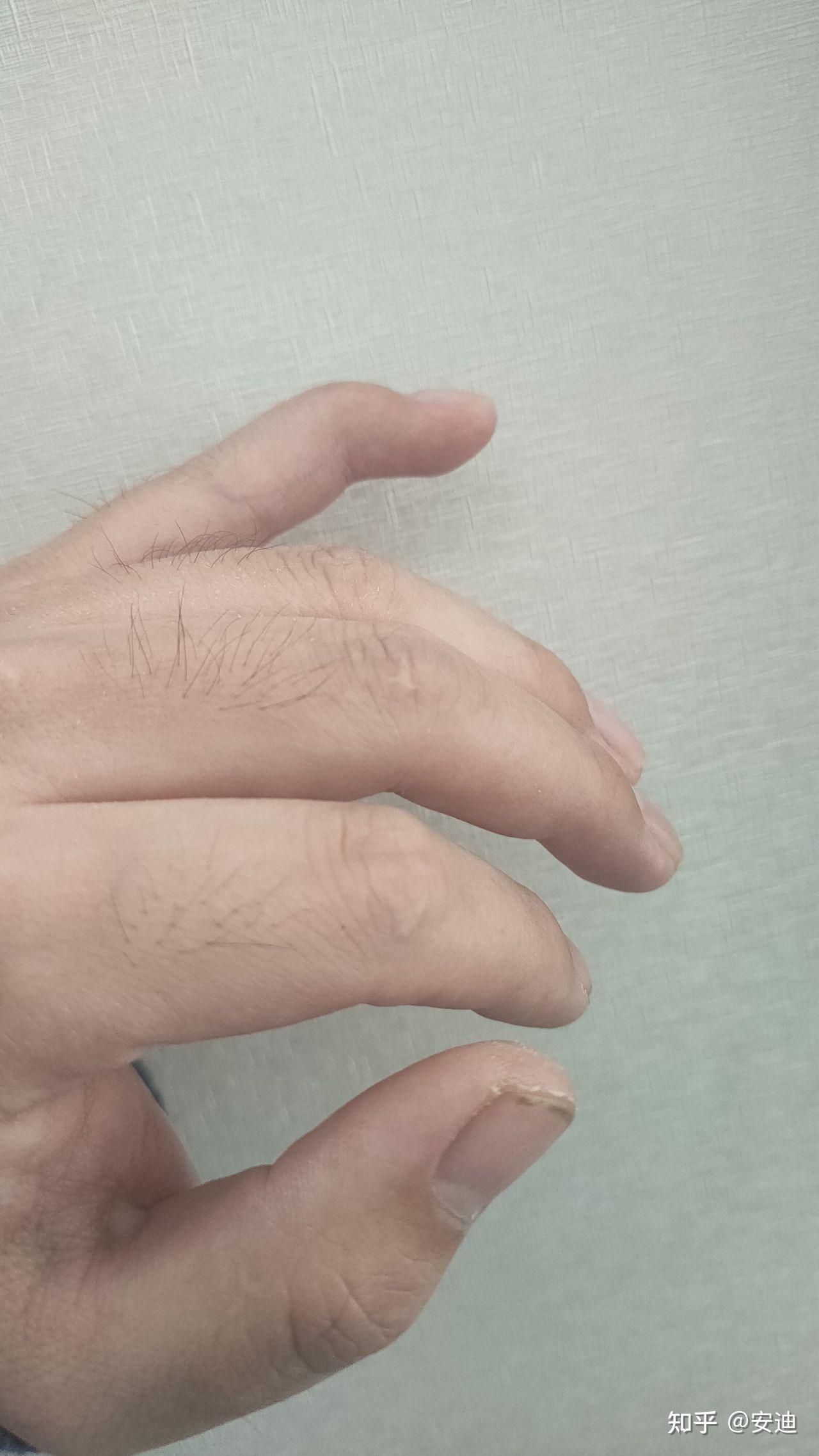 小指末关节肌腱断裂保守治疗详细解说
