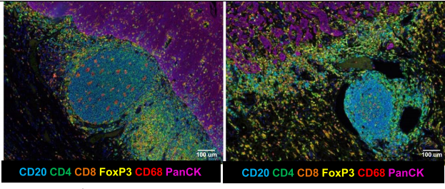 三级淋巴结构在肿瘤微环境中的作用 - 知乎