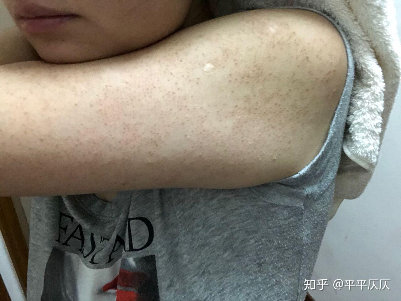 苏打粉治疗鸡皮肤(有没有治疗鸡皮肤的方法)