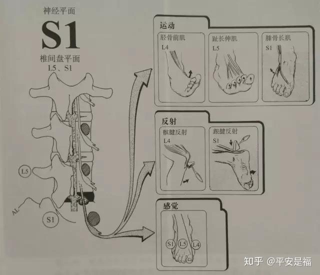 圖2-36l4/5椎間盤突出累及l5神經根,l4/5節段椎間盤突出在腰椎中的第