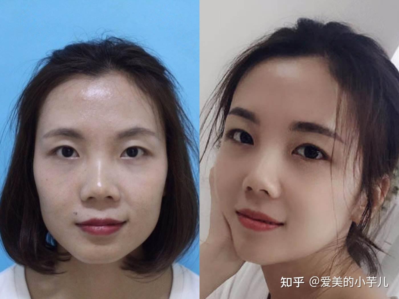 国内最全磨骨医生测评（下颌角颧骨谁的技术好？） - 知乎