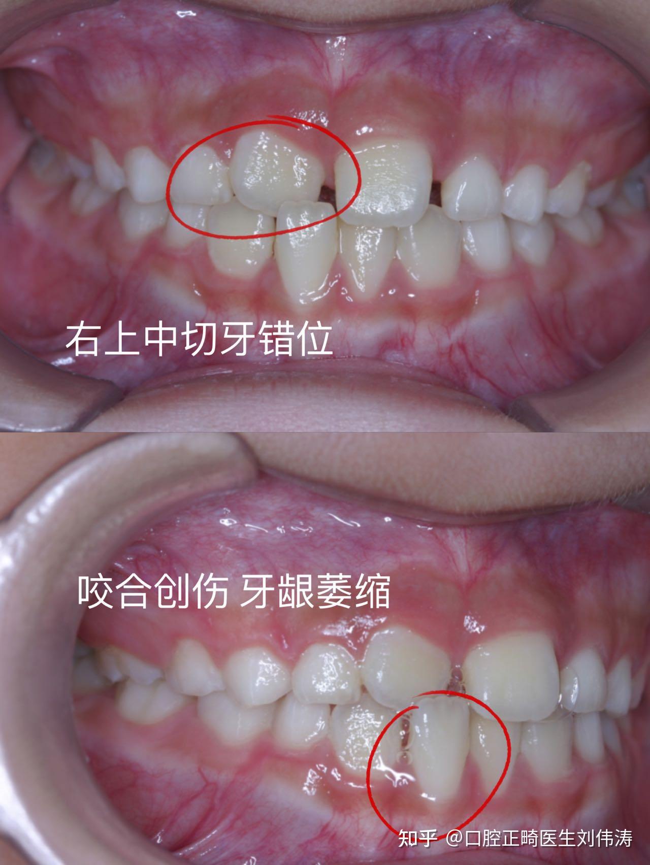 郑州牙齿矫正丨错颌畸形的危害性 - 知乎