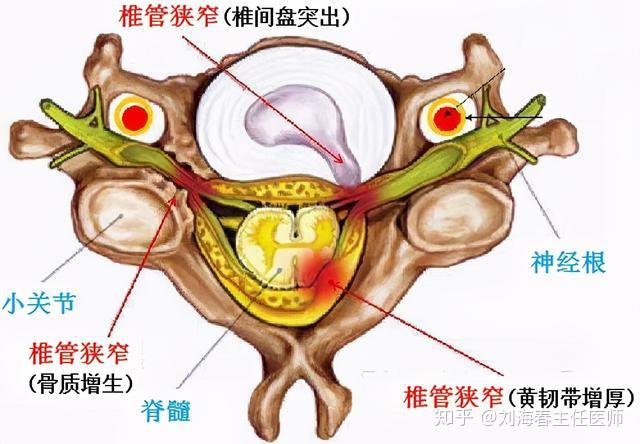 老年人走走停停,警惕腰椎管狭窄!