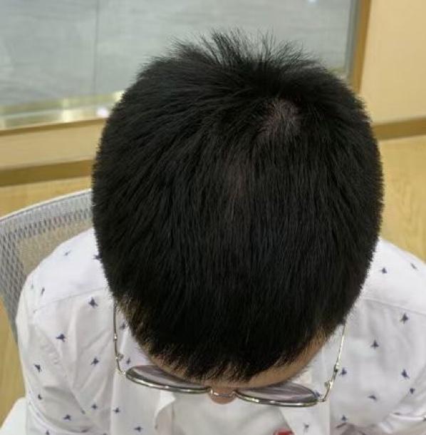 仁爱植发咋样(仁爱整形美容医院官网)