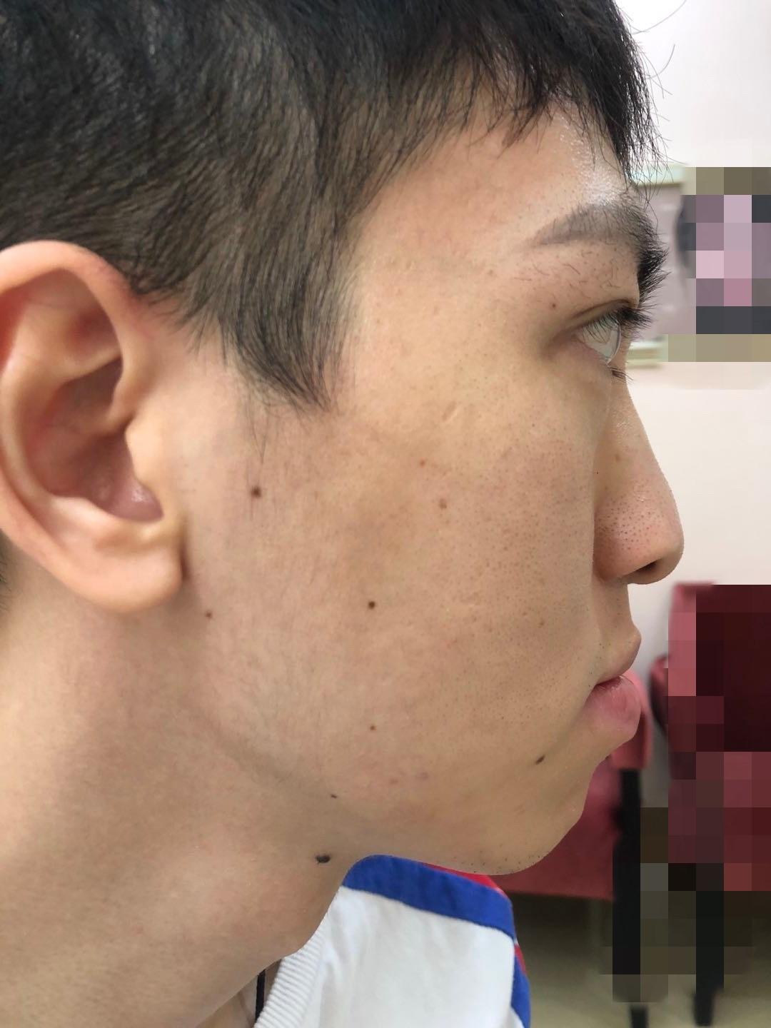 【案例分析】这位患者鼻唇轻微畸形，为更好看些做手术修复_上唇_皮肤_红唇