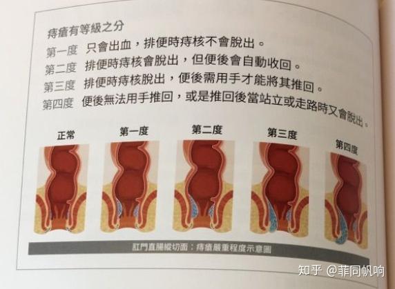 混合痔术后20多天小结——痔疮君传奇的一生