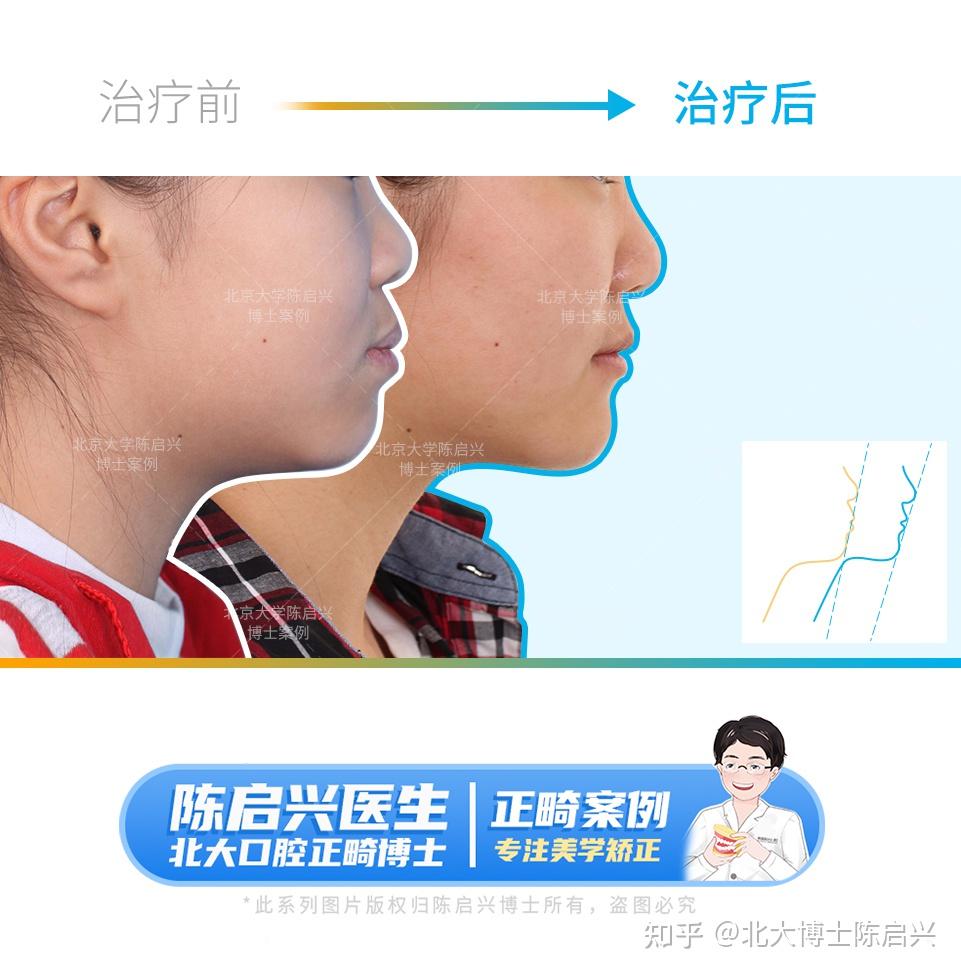 青少年矫正案例 | 嘴凸+大小脸+重度拥挤不齐 - 知乎