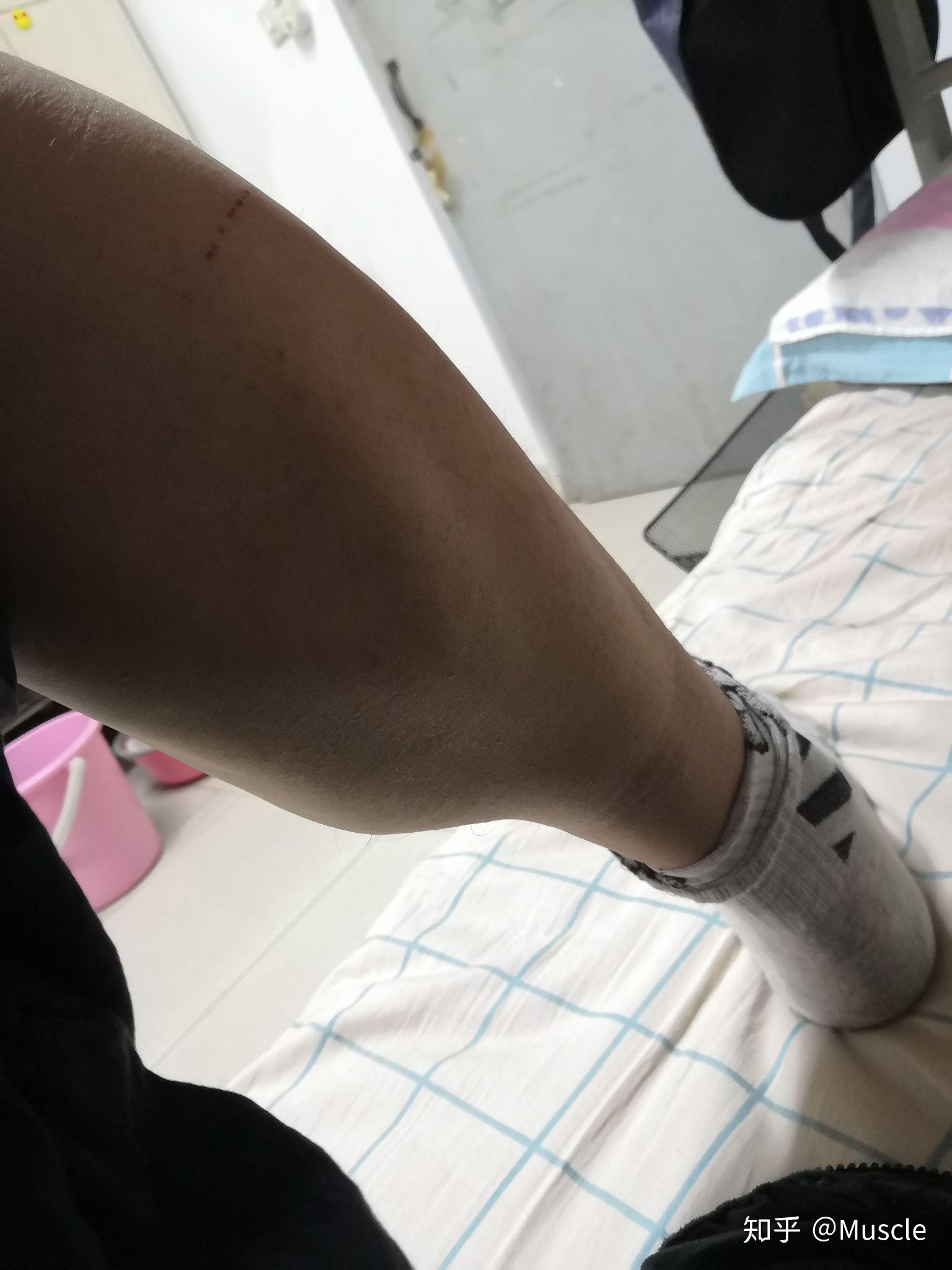 小腿跟腱很粗怎么办啊?