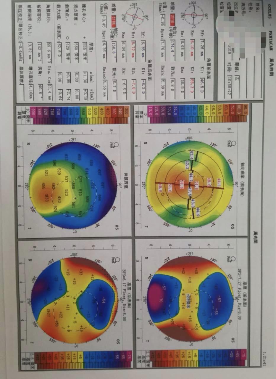 角膜曲率高一定是圆锥角膜吗