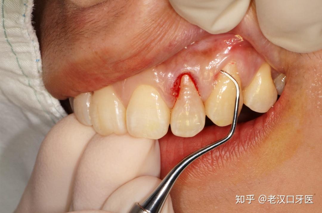 解决牙龈萎缩把失去的牙龈补回来