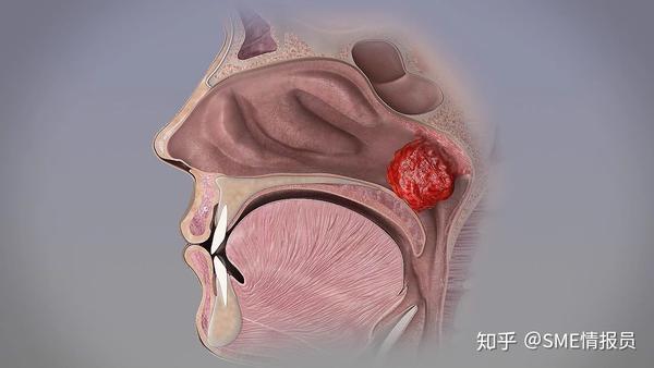 球大小的腺樣體阻塞鼻腔通道