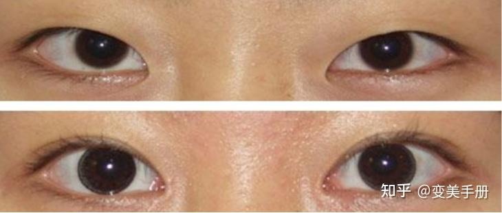 它遮掩着内眦角,使内眦角角度较没有内眦赘皮的人为小,它还遮挡部分