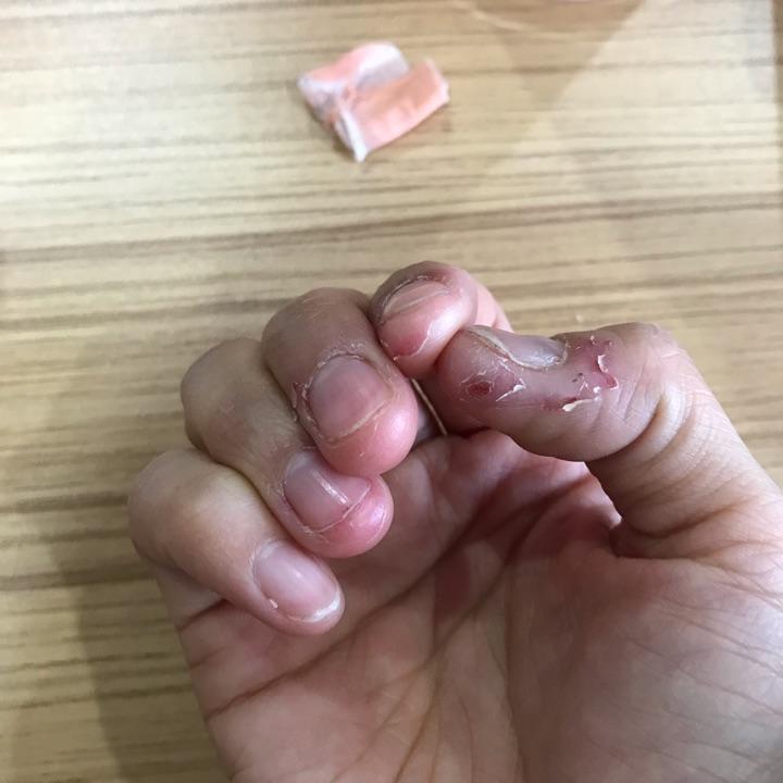如何控制不自觉的没完没了的撕手皮如何恢复手指皮肤的状态比如已经撕