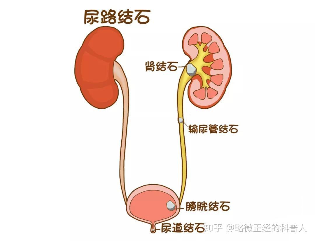 肾结石的犯罪之路