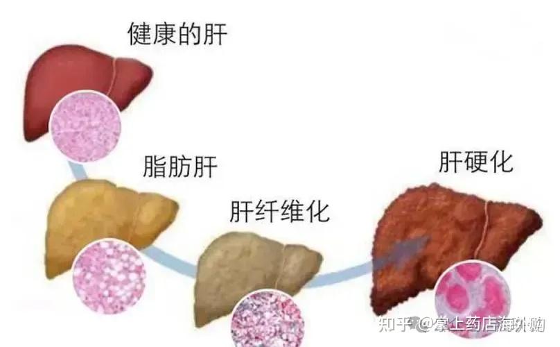 别让肝纤维化毁了你的肝脏！肝纤维化=肝硬化吗？ - 知乎