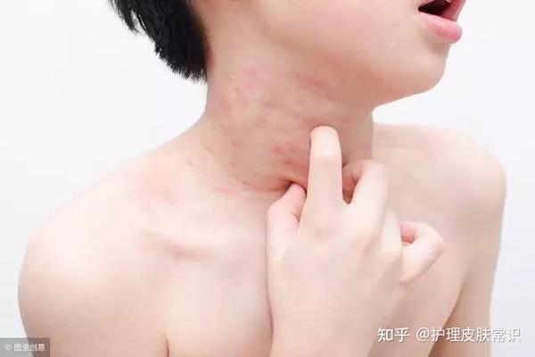 肤康 科普 湿疹的症状有哪些 这些得赶紧注意了 知乎 肤康 科普 湿疹的症状有哪些 这些得赶紧注意了 知乎