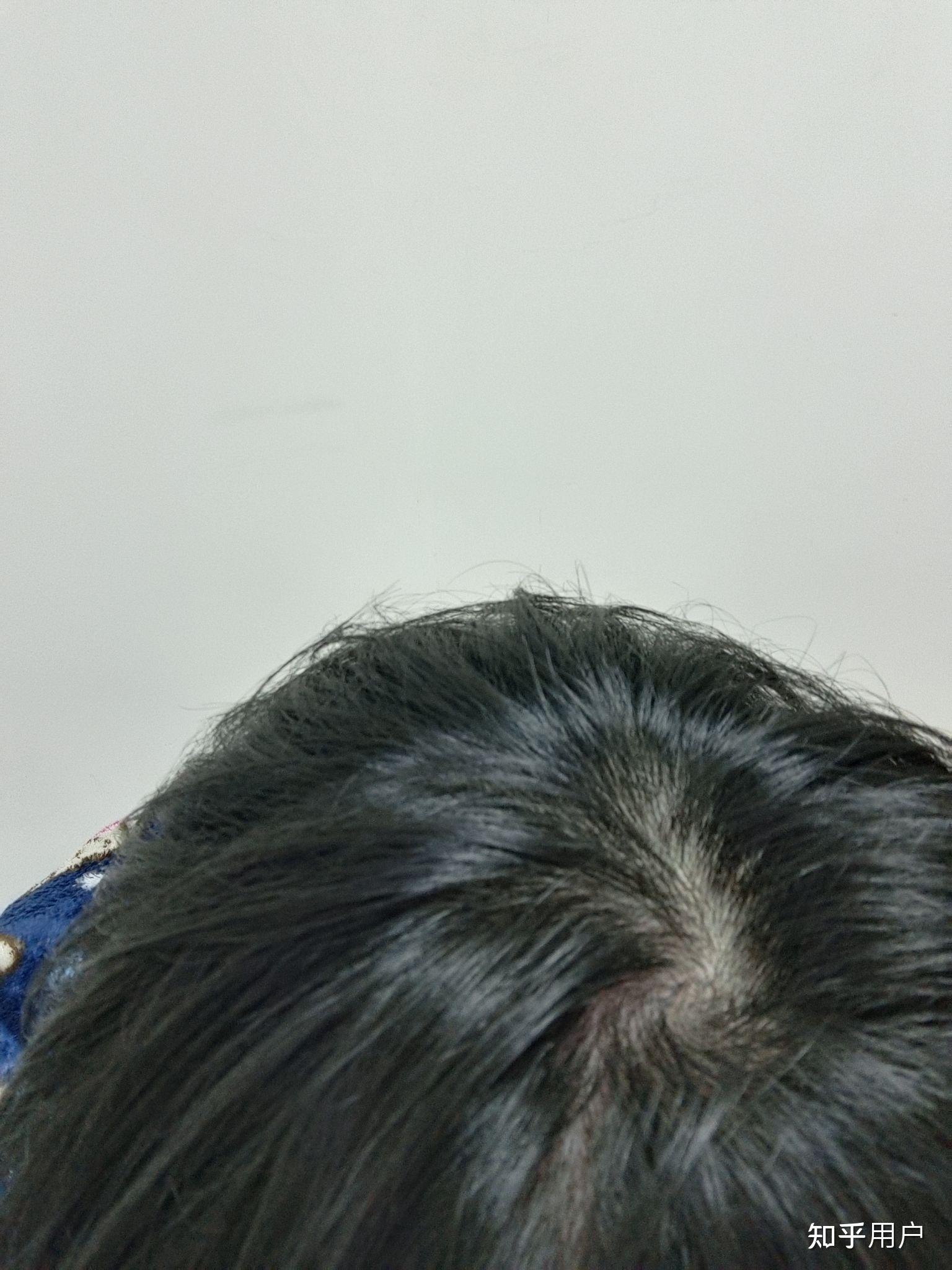我这头顶漩涡处头发量正常吗? - 知乎