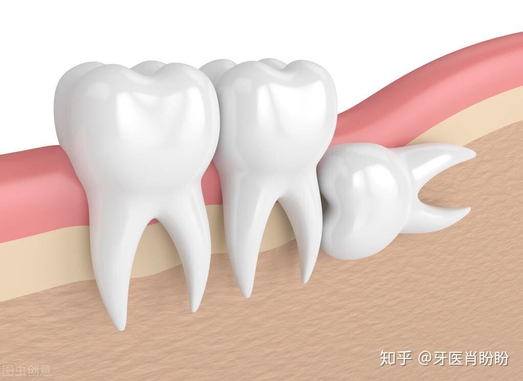 醫生又說智齒不能久留那為什麼不給我一次性全拔掉