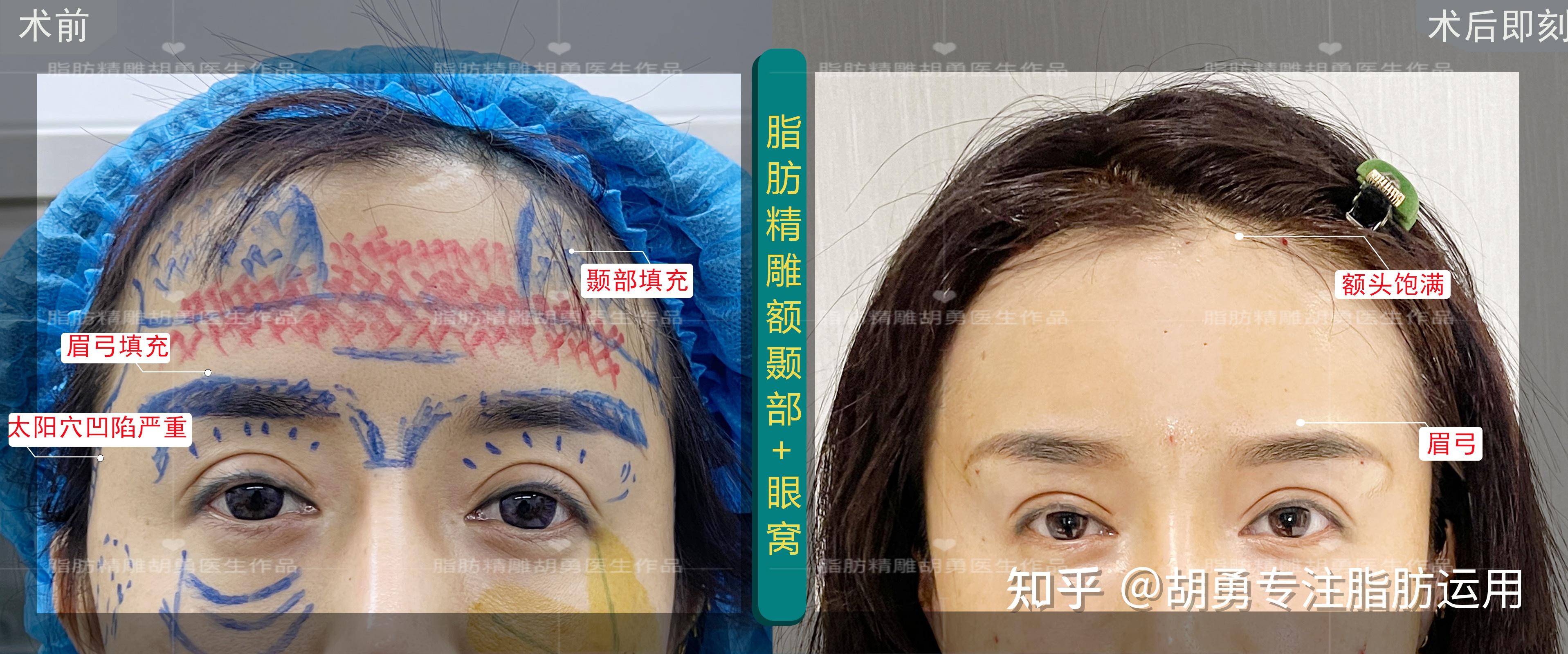眼窝+眉弓+太阳穴额颞部填充术前vs术后即刻vs术后6天 - 知乎