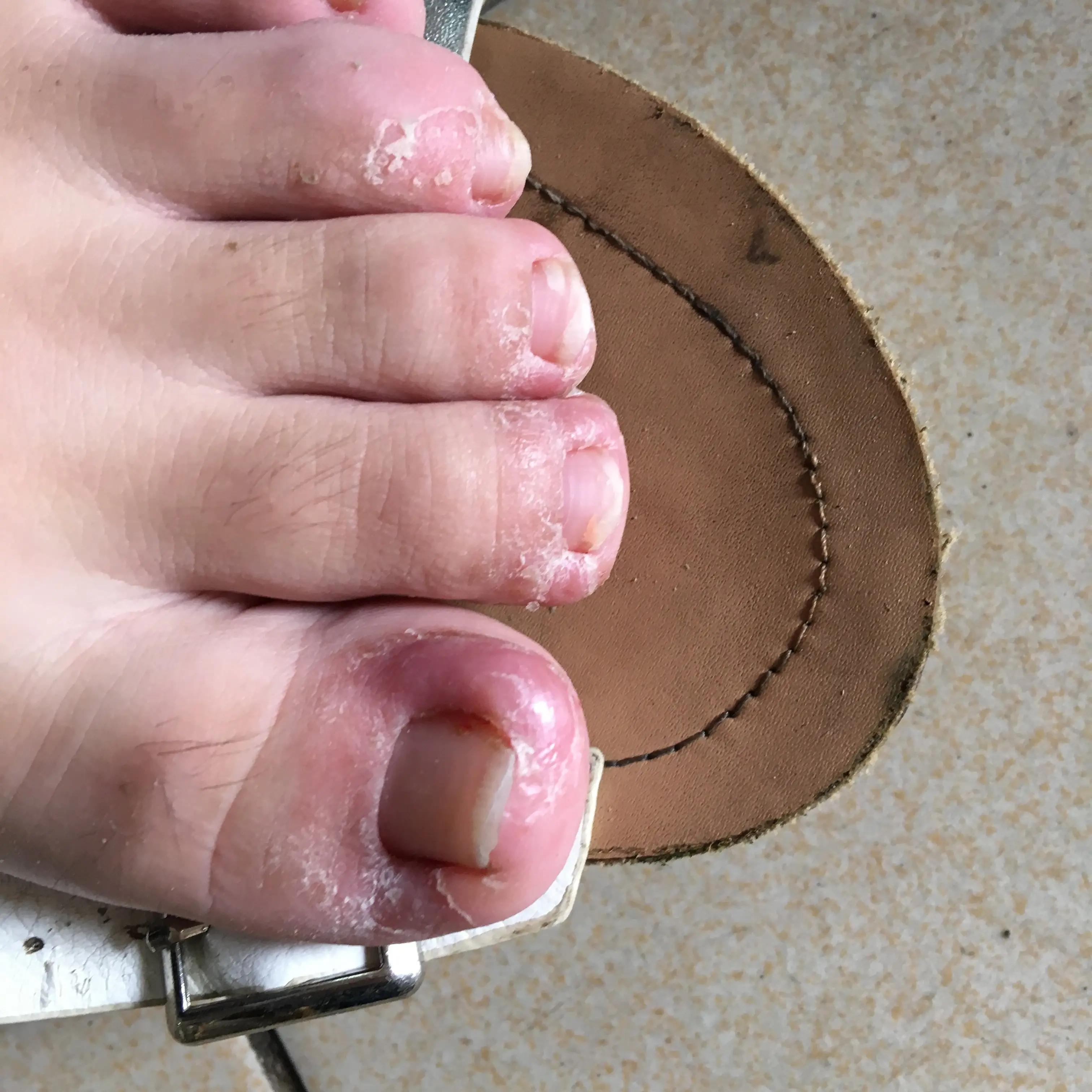 用这种方法轻松除甲沟炎,不拔甲不疼痛,恢复还快! - 知乎