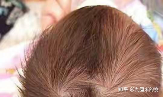 头顶旋的形成：解密毛发旋转的秘密 - 知乎