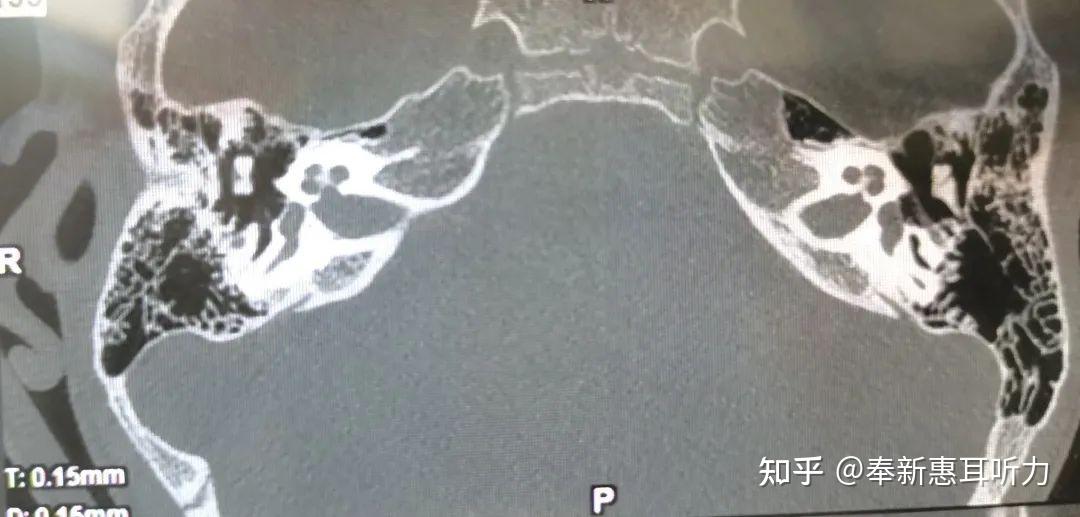 听神经细小系列科普|(一)如何精准诊断听神经细小(影像学特征 - 知乎