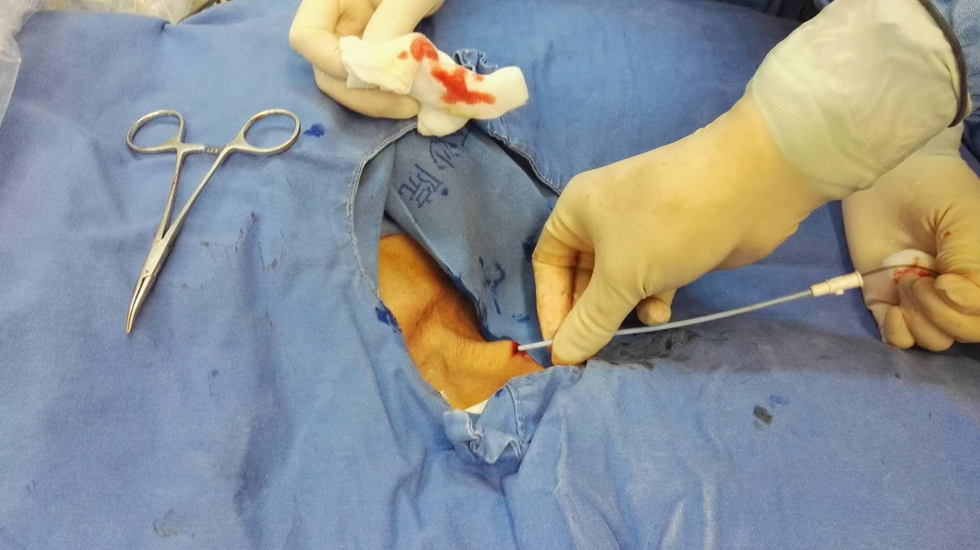 柳暗花明经颈外静脉带cuff透析导管置入