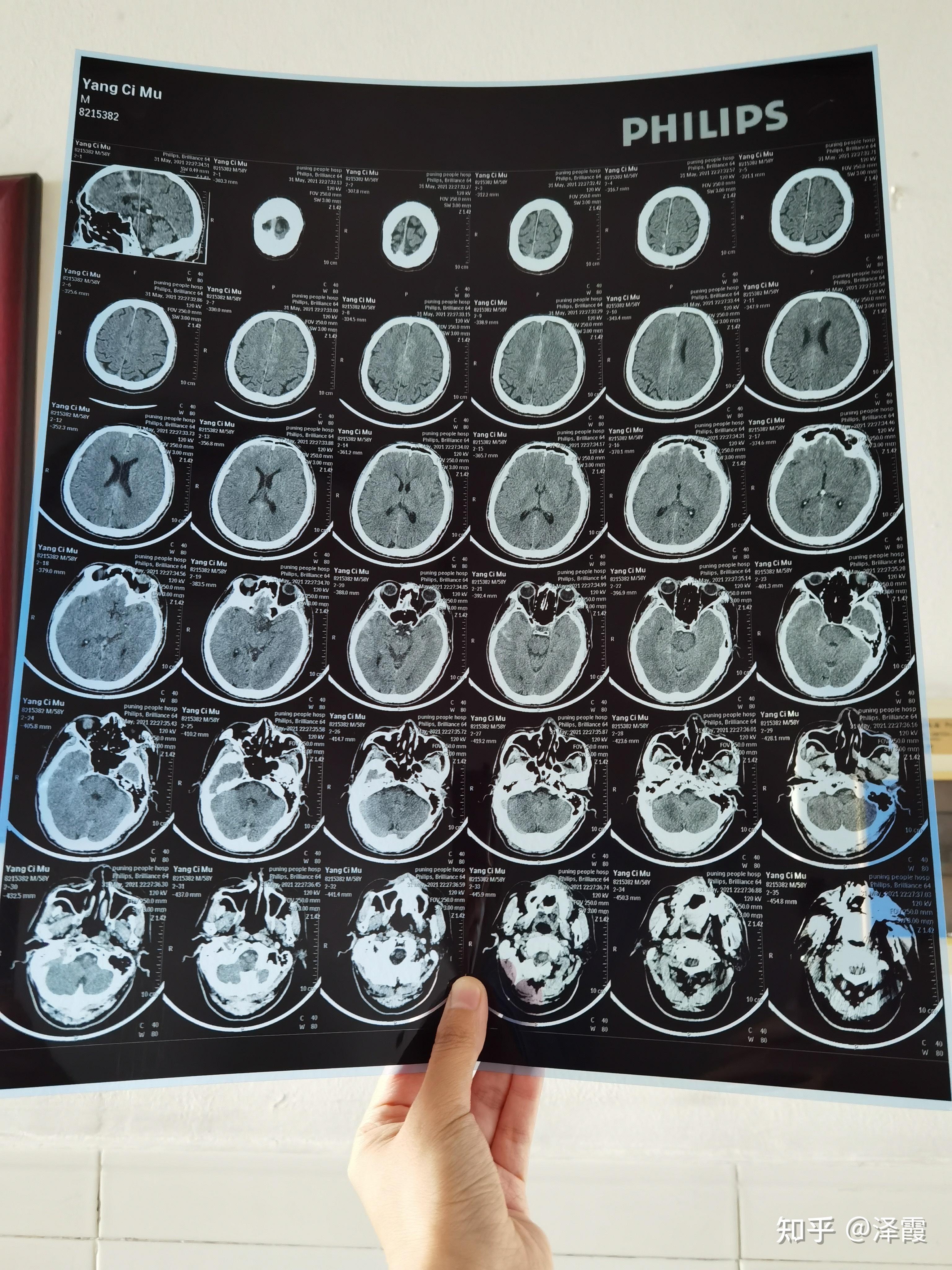脑CT片子图片