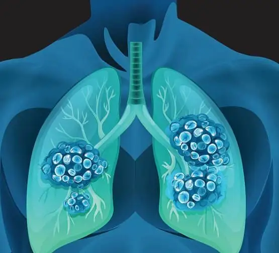 慢阻肺肺气肿的5大合并症是引起生活质量下降和死亡的重要原因!