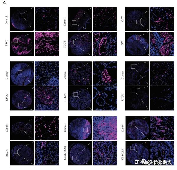 8+SCI，单基因泛癌生信+表达验证+单细胞泛癌。单基因泛癌的经典思路，不得不服，即便再过两年，仍然可以发文！ - 知乎