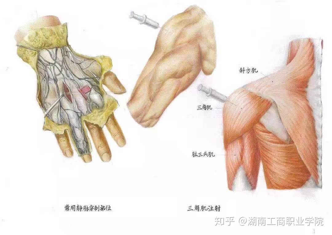 ▼三等獎作品《常見護理技能(手背靜脈網給藥,三角肌注射解剖示意圖)