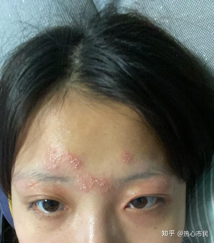 被隐翅虫毒液侵蚀的悲伤心情