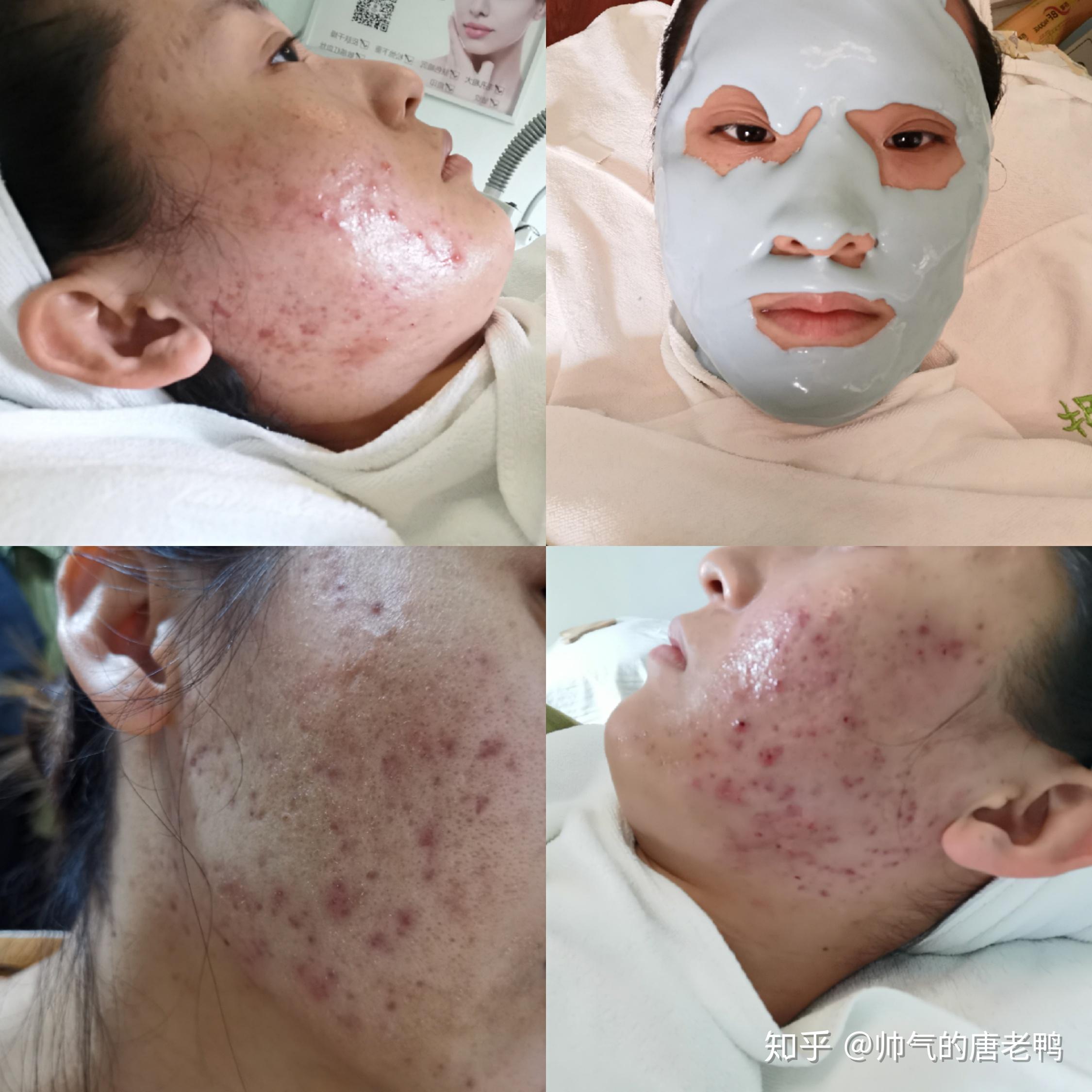 脂溢性皮炎痘痘肌康复过程