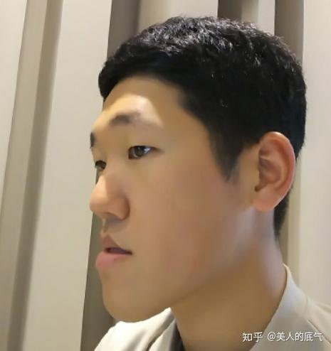 爱美容研社从鞋拔子地包天脸秒变男神来看看他的韩国双鄂手术的矫正