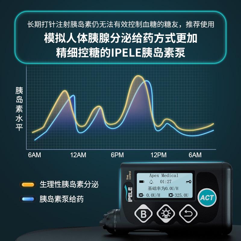 胰島素泵,模擬正常胰島素的分泌模式,俗稱