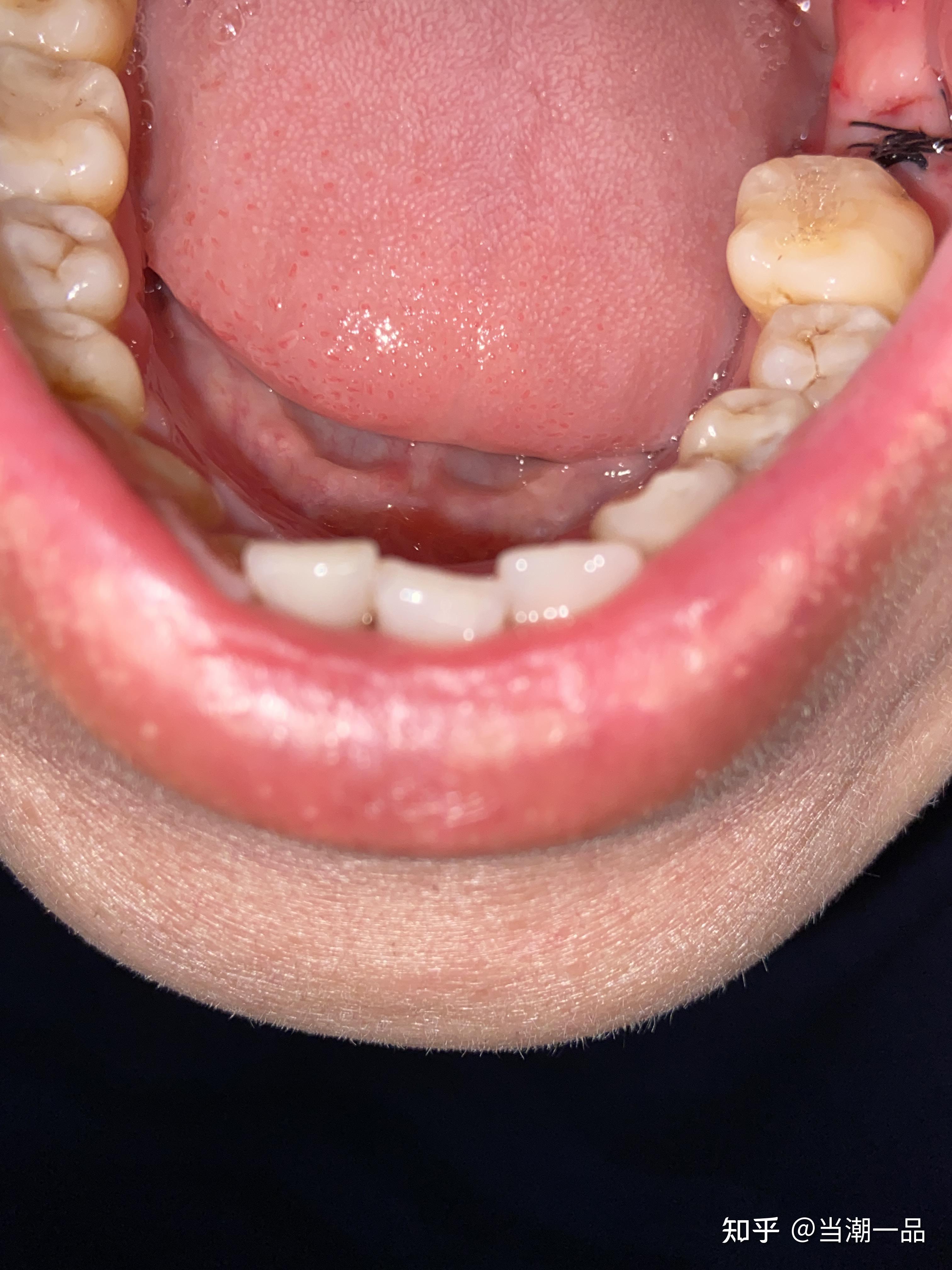 我的种植牙全记录