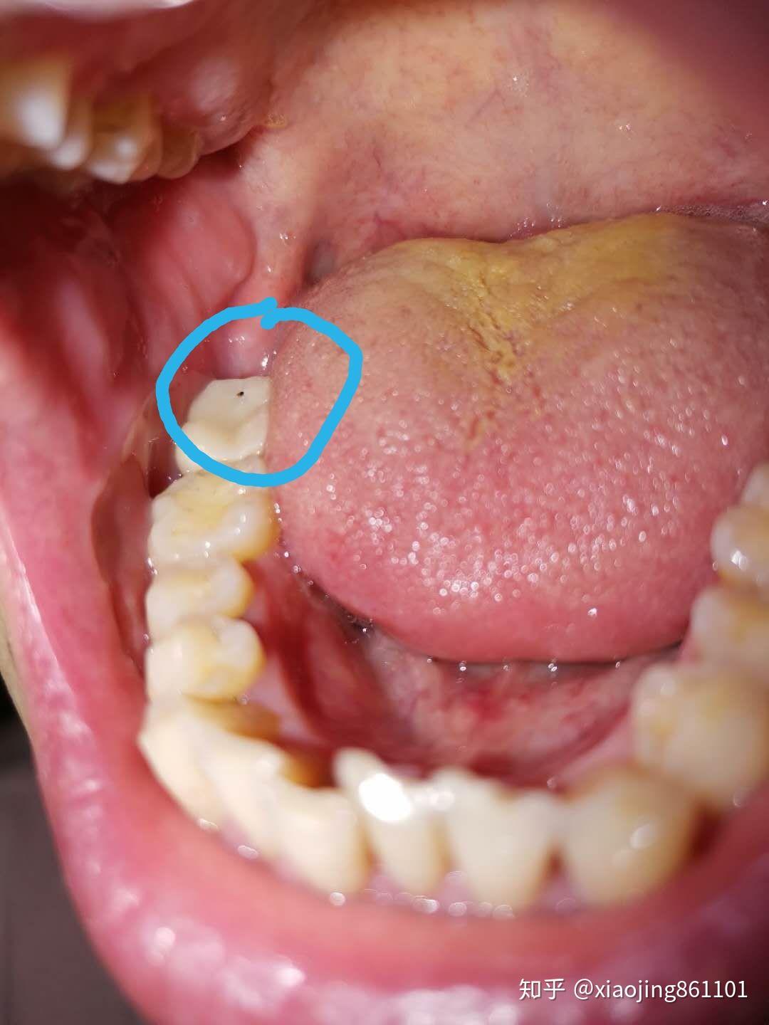 請問大家做了不到一個月的全瓷牙竟然有個洞醫生說是咬合正常現象這個