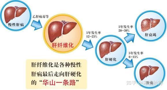 長期乙肝病毒攜帶,查出肝纖維化,什麼原因,怎麼逆轉,治療方法有哪些?