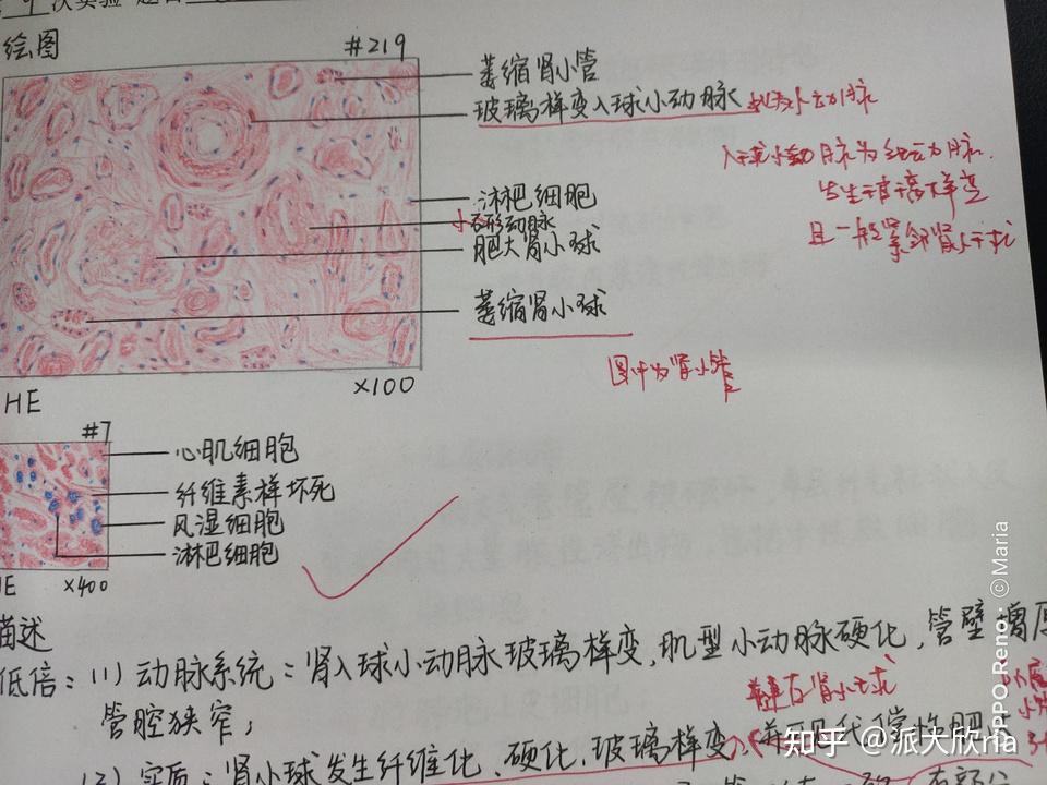 肾浊肿手绘实验报告图图片