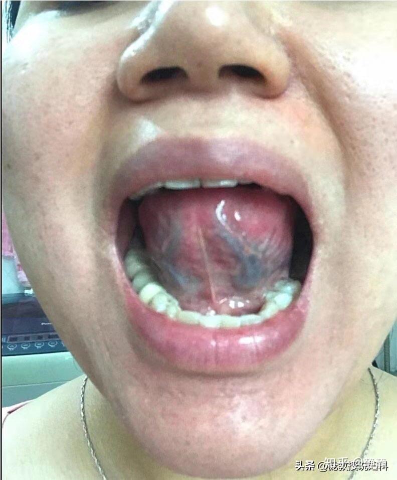 舌头下面红血丝明显图片